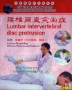 Lumbar Intervertebral Disc Protrusion, Chinese Medicine DVD Lumbar Intervertebral Disc Protrusion, Chinese Medicine DVD